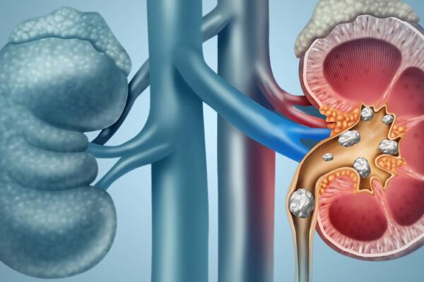 Methods of treatment to remove kidney stones