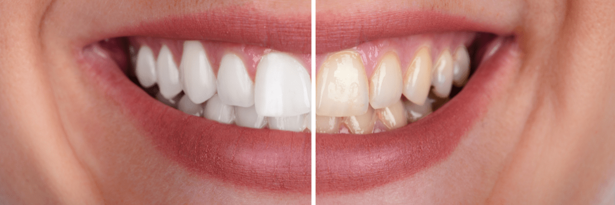 teeth whitening