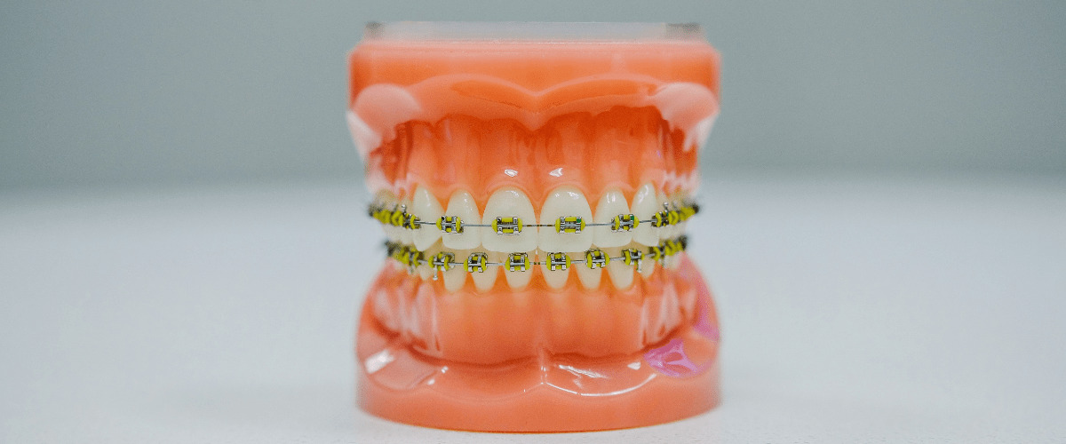 Braces Cost in Malaysia: All You Need to Know