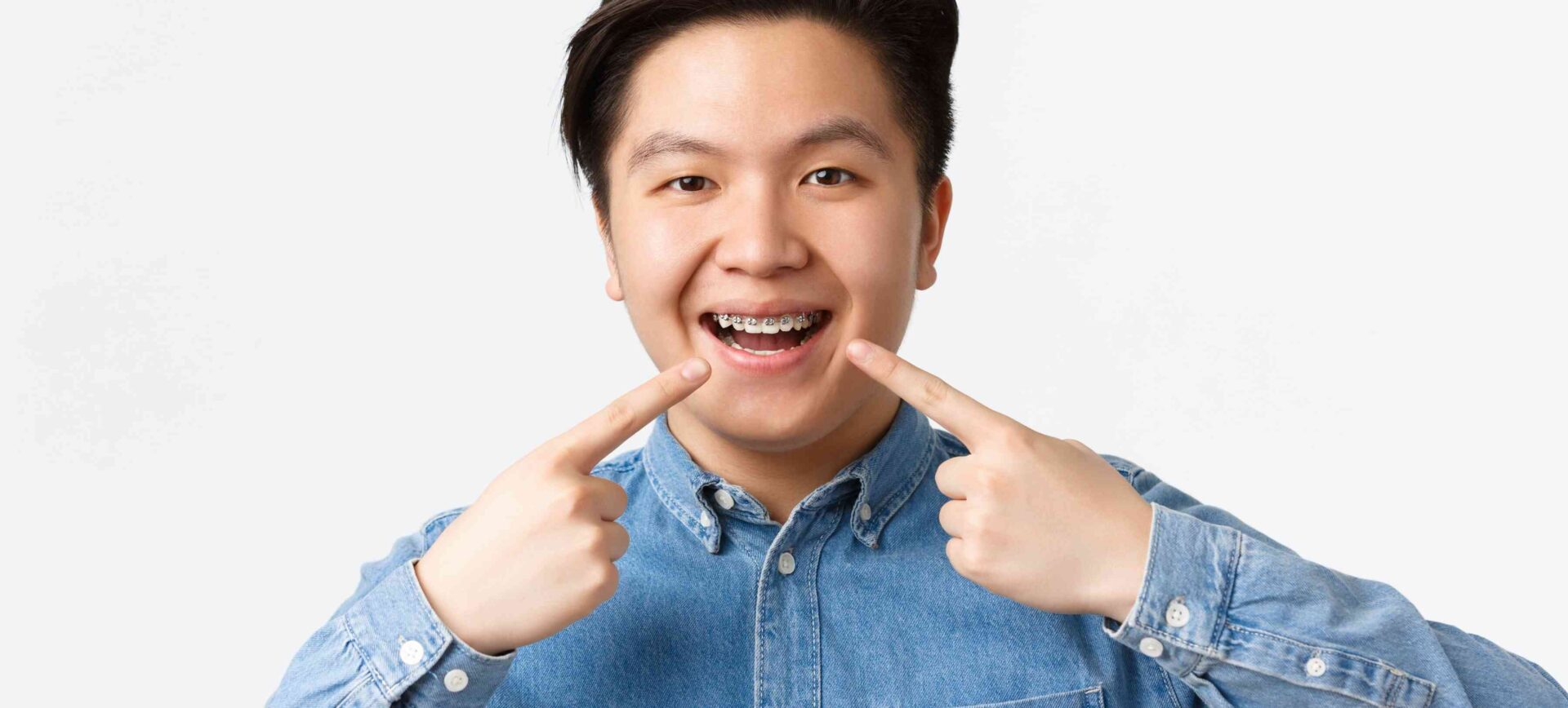 Self ligating braces vs traditional braces