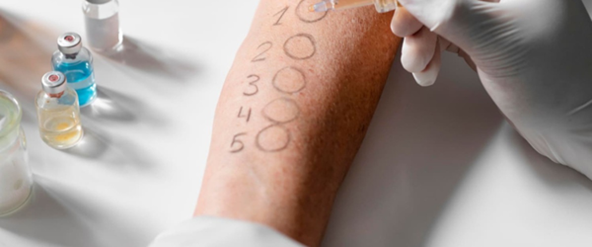 allergy-test