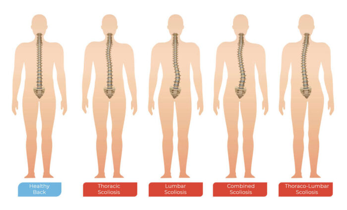 Scoliosis