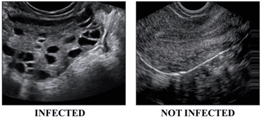 Visual comparison of ultrasound images from patients with and without PCOS