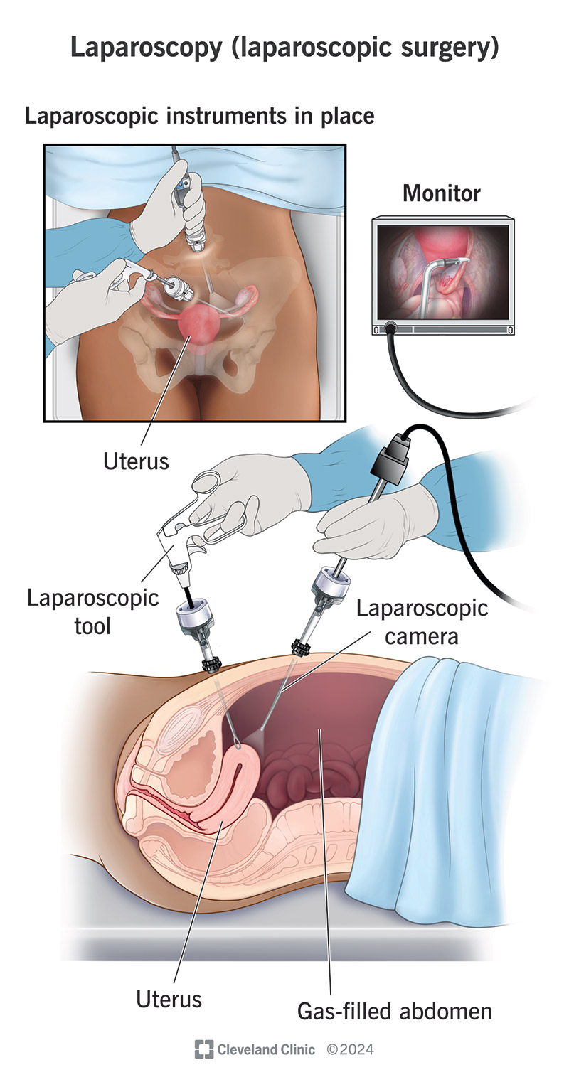 Diagram of Laparoscopy Surgery